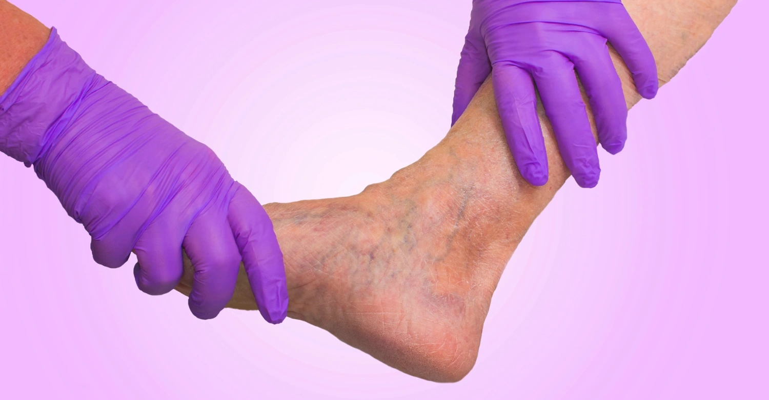 Chronic Venous Insufficiency and Periodontal Health1